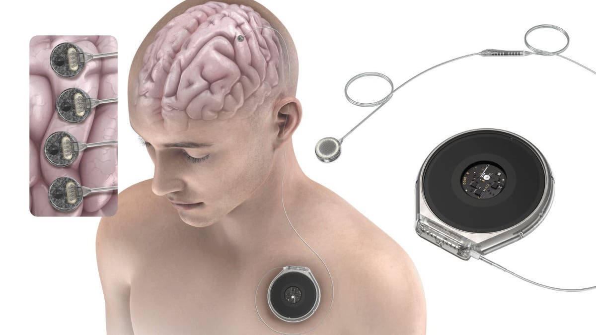 Brain implant 4